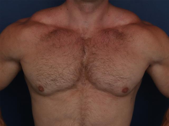 Gynecomastia Surgery before at Ronald H. Schuster, MD in Timonium, MD