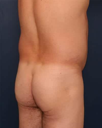 Brazilian Butt Lift before at Ronald H. Schuster, MD in Timonium, MD
