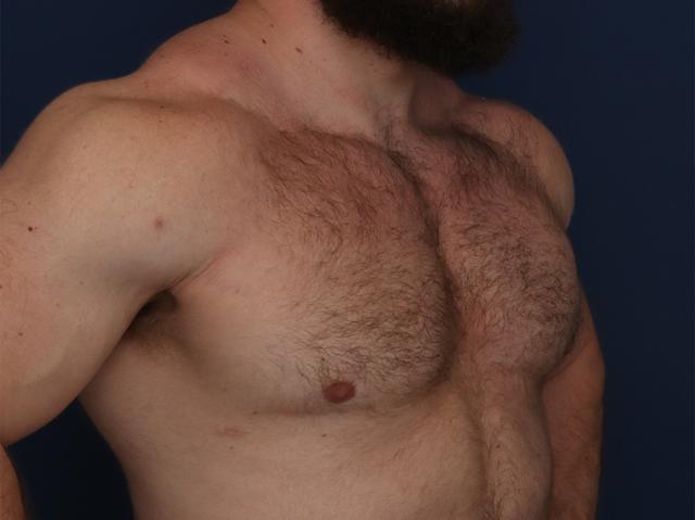 Gynecomastia Surgery after at Ronald H. Schuster, MD in Timonium, MD