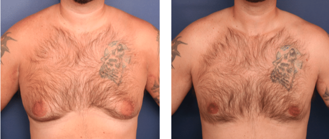 Gynecomastia Surgery result at Ronald H. Schuster, MD in Timonium, MD