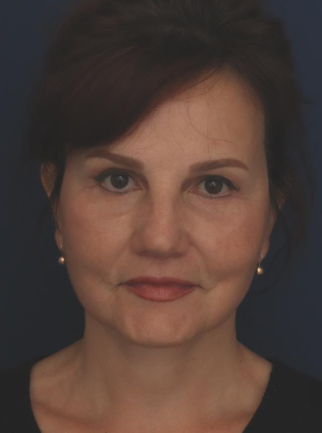 Facelift after at Ronald H. Schuster, MD in Timonium, MD