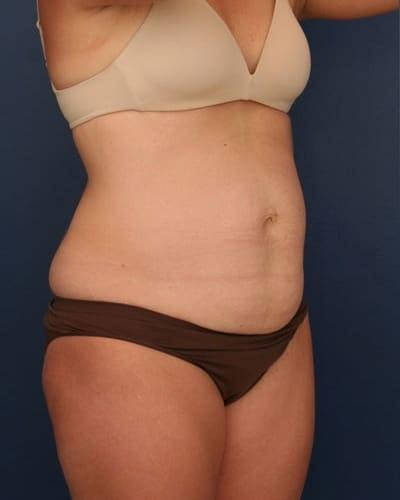 Mini Tummy Tuck before at Ronald H. Schuster, MD in Timonium, MD