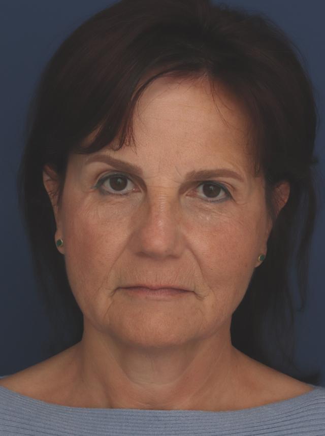 Facelift before at Ronald H. Schuster, MD in Timonium, MD