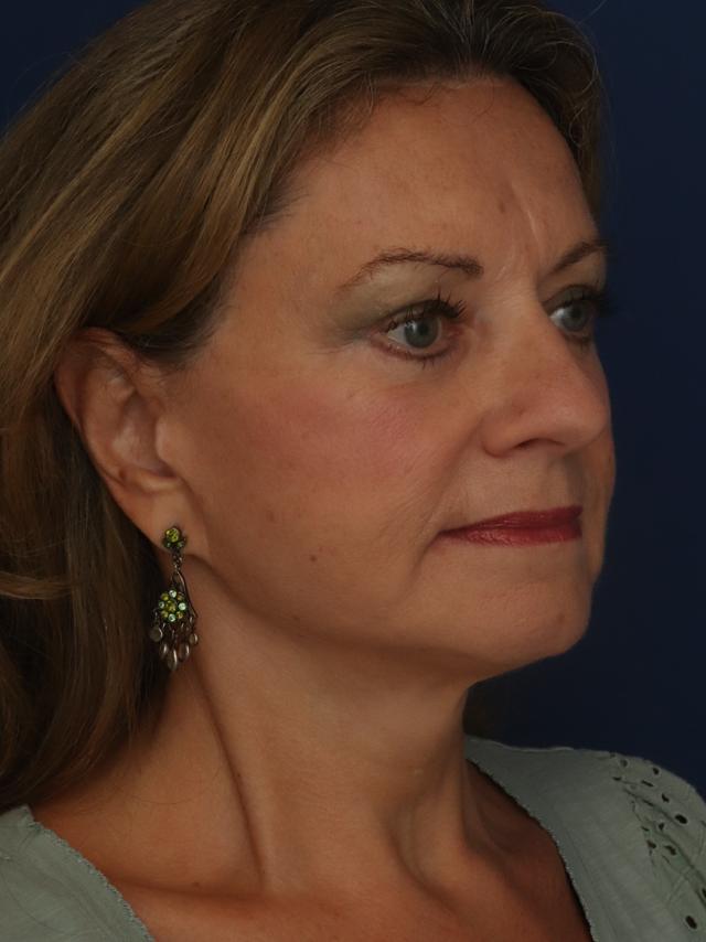 Facelift after at Ronald H. Schuster, MD in Timonium, MD