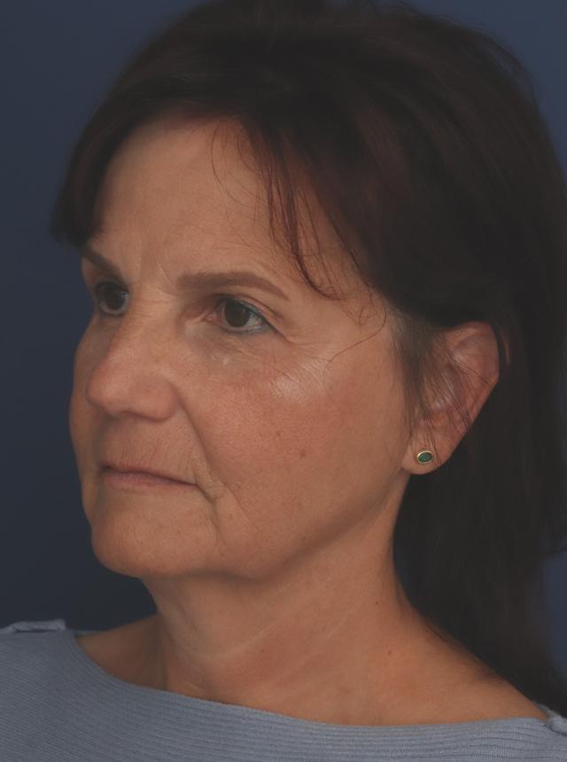 Facelift before at Ronald H. Schuster, MD in Timonium, MD