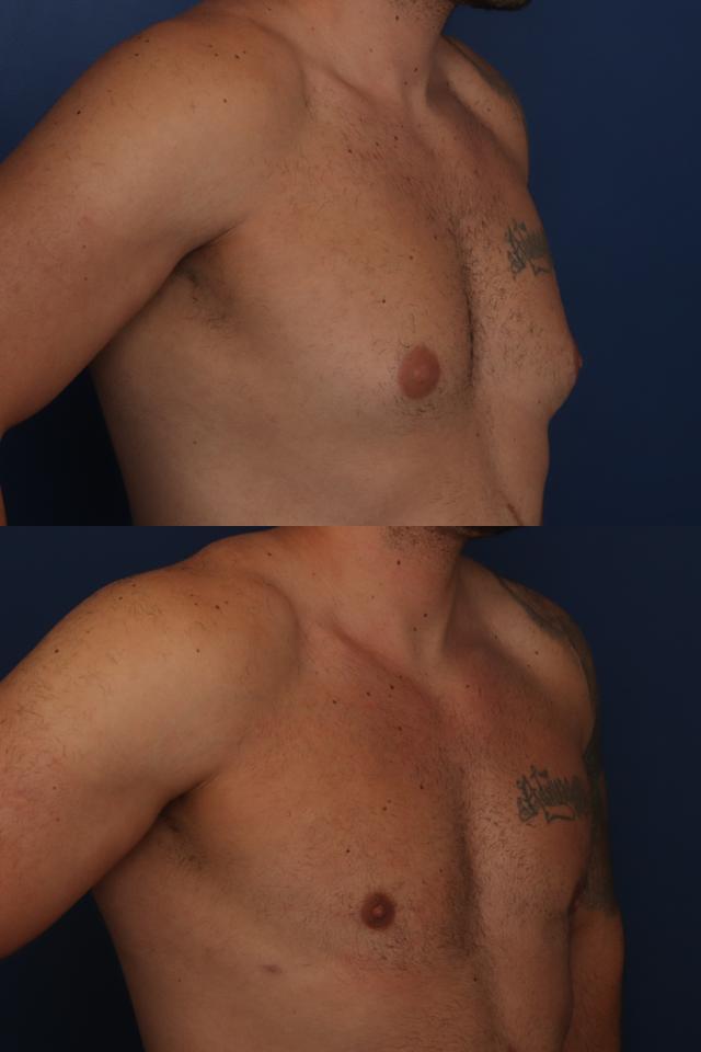 Gynecomastia Surgery result at Ronald H. Schuster, MD in Timonium, MD