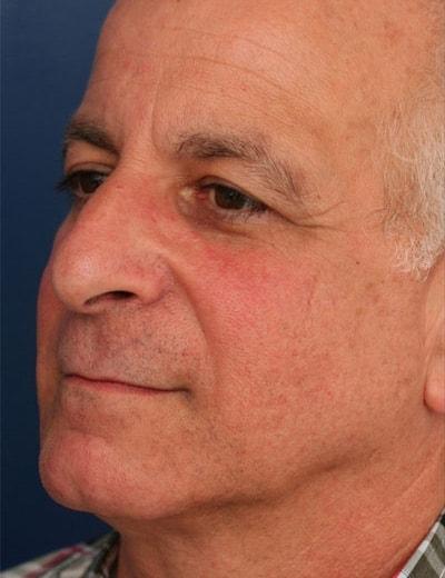 Functional Rhinoplasty before at Ronald H. Schuster, MD in Timonium, MD