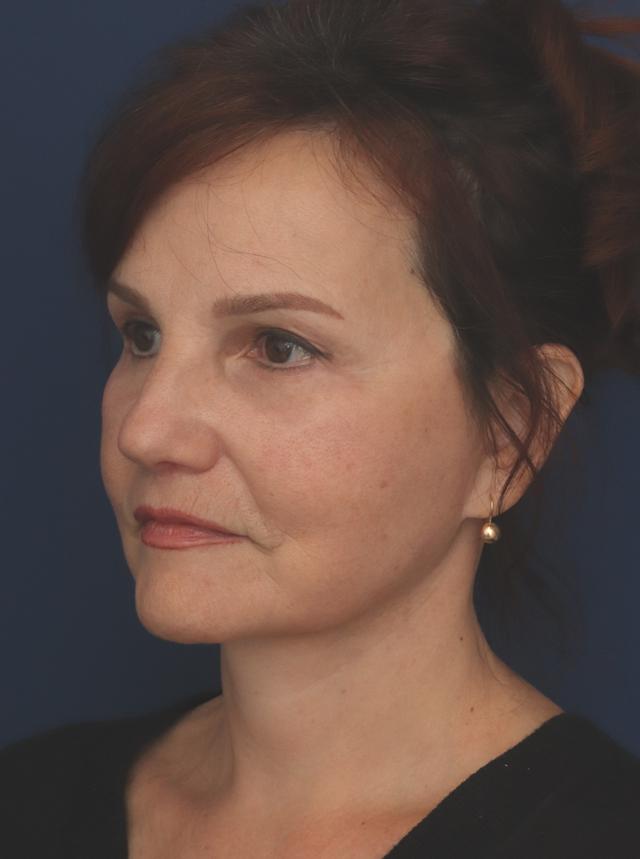 Facelift after at Ronald H. Schuster, MD in Timonium, MD