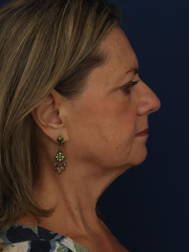 Facelift before at Ronald H. Schuster, MD in Timonium, MD