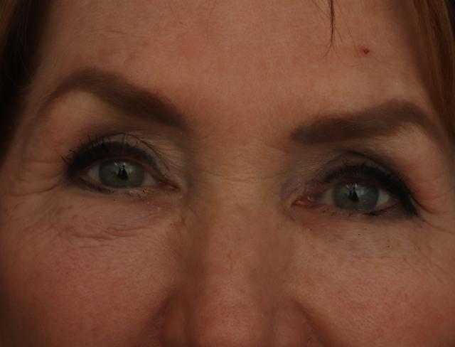 Blepharoplasty before at Ronald H. Schuster, MD in Timonium, MD