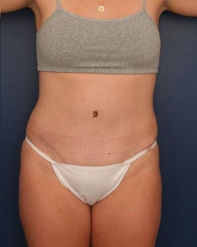 Ronald H. Schuster, MD tummy tuck after — Timonium, MD