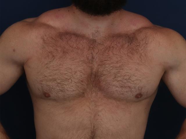 Gynecomastia Surgery after at Ronald H. Schuster, MD in Timonium, MD