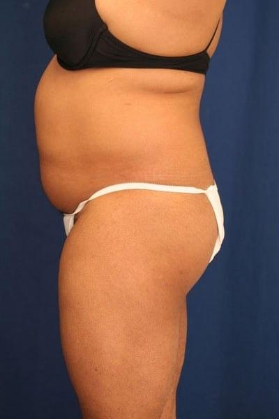 Brazilian Butt Lift before at Ronald H. Schuster, MD in Timonium, MD