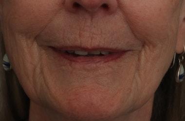 Laser Skin Resurfacing before at Ronald H. Schuster, MD in Timonium, MD