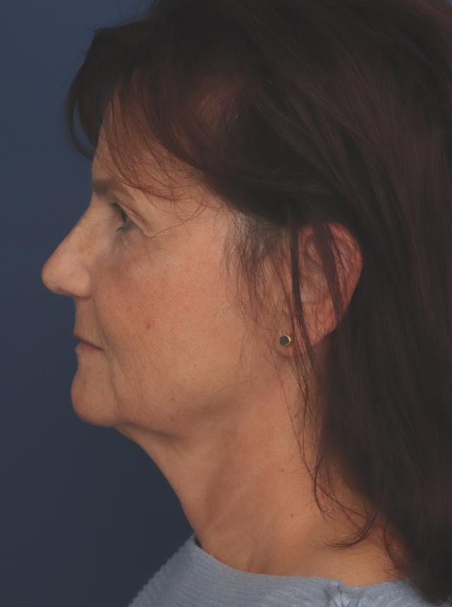Facelift before at Ronald H. Schuster, MD in Timonium, MD