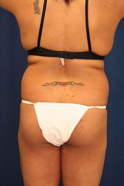 Brazilian Butt Lift before at Ronald H. Schuster, MD in Timonium, MD