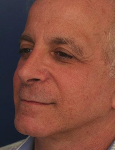 Functional Rhinoplasty after at Ronald H. Schuster, MD in Timonium, MD