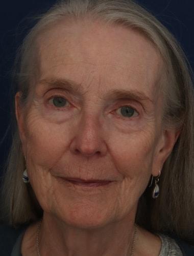 Laser Skin Resurfacing before at Ronald H. Schuster, MD in Timonium, MD