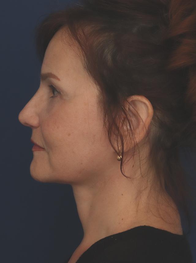 Facelift after at Ronald H. Schuster, MD in Timonium, MD