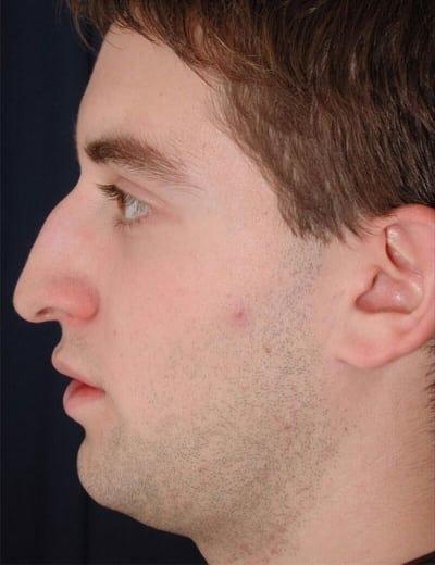 Functional Rhinoplasty before at Ronald H. Schuster, MD in Timonium, MD