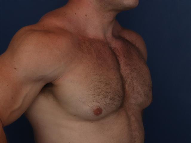 Gynecomastia Surgery before at Ronald H. Schuster, MD in Timonium, MD