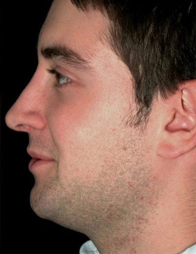 Functional Rhinoplasty after at Ronald H. Schuster, MD in Timonium, MD