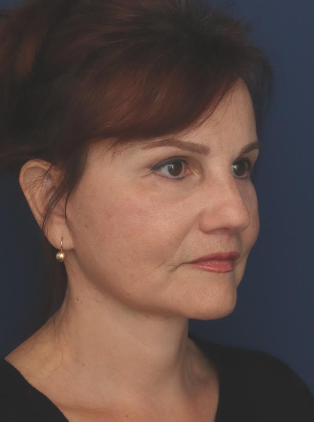 Facelift after at Ronald H. Schuster, MD in Timonium, MD