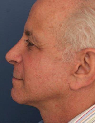 Rhinoplasty after at Ronald H. Schuster, MD in Timonium, MD