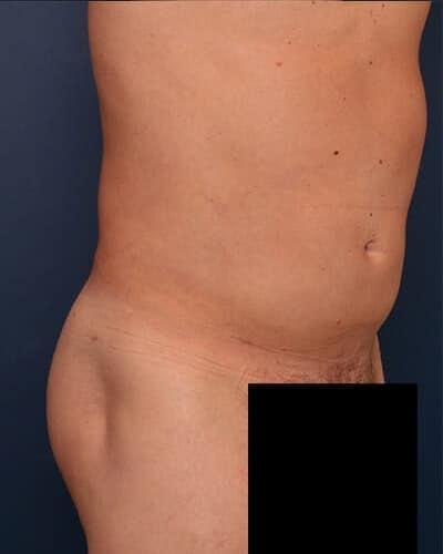 Thigh Lift after at Ronald H. Schuster, MD in Timonium, MD