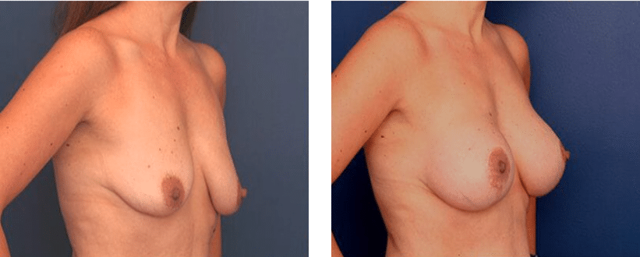 Breast Augmentation result at Ronald H. Schuster, MD in Timonium, MD