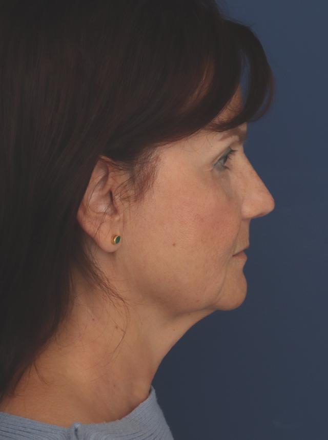 Facelift before at Ronald H. Schuster, MD in Timonium, MD