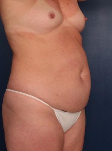 Mommy Makeover before at Ronald H. Schuster, MD in Timonium, MD