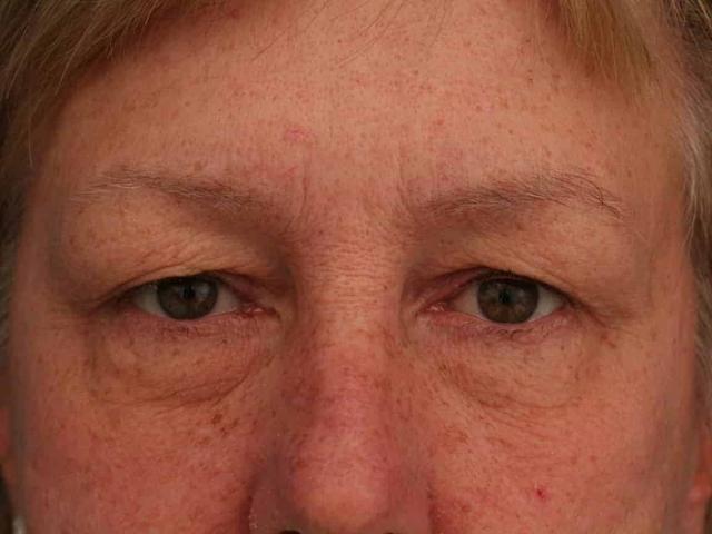 Blepharoplasty before at Ronald H. Schuster, MD in Timonium, MD