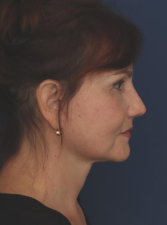 Facelift after at Ronald H. Schuster, MD in Timonium, MD