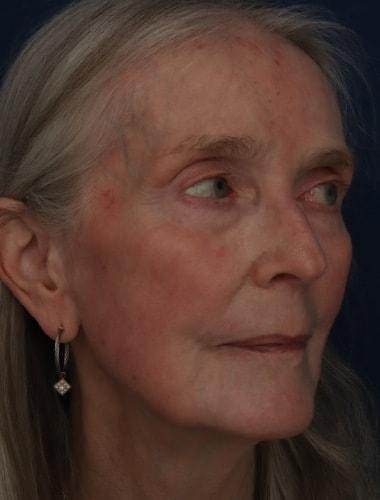 Laser Skin Resurfacing after at Ronald H. Schuster, MD in Timonium, MD