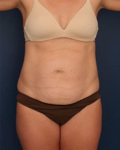Mini Tummy Tuck before at Ronald H. Schuster, MD in Timonium, MD