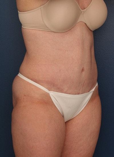Ronald H. Schuster, MD tummy tuck after — Timonium, MD