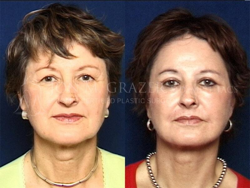Jon Grazer MD Plastic Surgery & Aesthetics facelift result — Newport Beach, CA