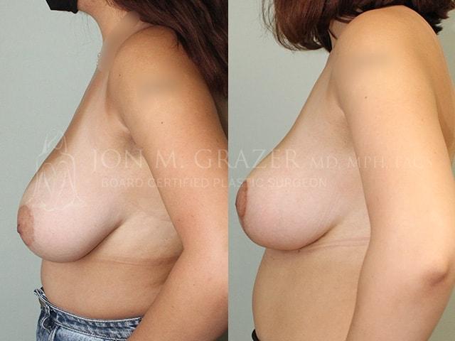 Breast Reduction result at Jon Grazer MD Plastic Surgery & Aesthetics in Newport Beach, CA