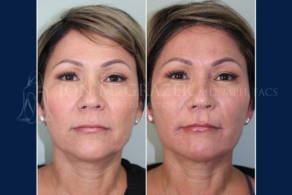 Lip Filler result at Jon Grazer MD Plastic Surgery & Aesthetics in Newport Beach, CA