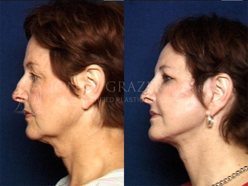 Jon Grazer MD Plastic Surgery & Aesthetics facelift result — Newport Beach, CA