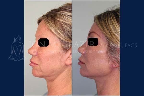 Mini Facelift result at Jon Grazer MD Plastic Surgery & Aesthetics in Newport Beach, CA