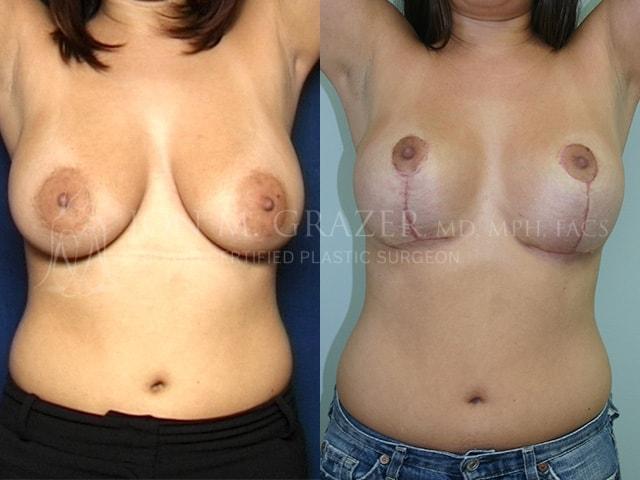 Breast Lift result at Jon Grazer MD Plastic Surgery & Aesthetics in Newport Beach, CA