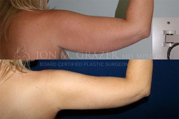 Arm Lift result at Jon Grazer MD Plastic Surgery & Aesthetics in Newport Beach, CA