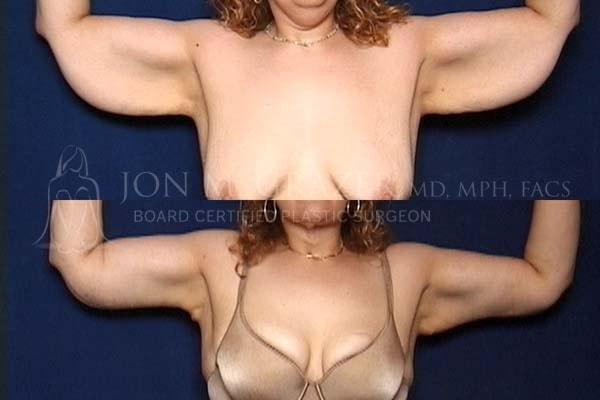 Arm Lift result at Jon Grazer MD Plastic Surgery & Aesthetics in Newport Beach, CA