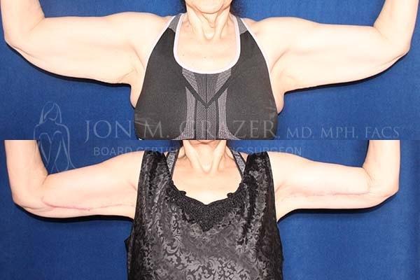 Arm Lift result at Jon Grazer MD Plastic Surgery & Aesthetics in Newport Beach, CA