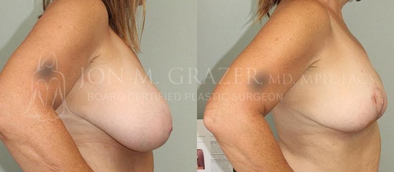 Jon Grazer MD Plastic Surgery & Aesthetics breast implant removal result — Newport Beach, CA