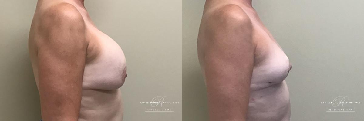 Randy Rudderman MD Plastic Surgery & Medical Spa breast augmentation result — Atlanta, GA