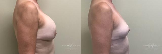 Breast Augmentation result at Randy Rudderman MD Plastic Surgery & Medical Spa in Atlanta, GA