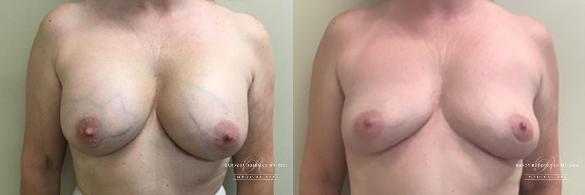 Randy Rudderman MD Plastic Surgery & Medical Spa breast augmentation result — Atlanta, GA